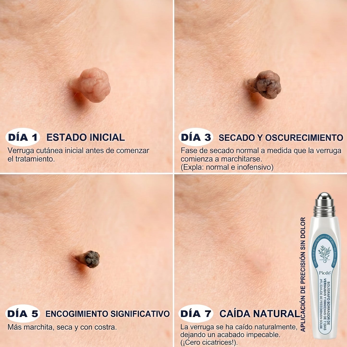 🏥🛒𝐏𝐢𝐜𝐝𝐨®  Borrador de Verrugas y Manchas en 7 Días (𝐀𝐩𝐥𝐢𝐜𝐚𝐝𝐨𝐫 𝐫𝐨𝐥𝐥-𝐨𝐧: 𝐬𝐢𝐧 𝐝𝐨𝐥𝐨𝐫 𝐧𝐢 𝐜𝐢𝐜𝐚𝐭𝐫𝐢𝐜𝐞𝐬)