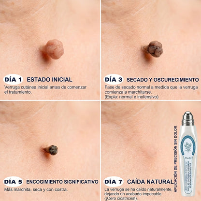 🏥🛒𝐏𝐢𝐜𝐝𝐨®  Borrador de Verrugas y Manchas en 7 Días (𝐀𝐩𝐥𝐢𝐜𝐚𝐝𝐨𝐫 𝐫𝐨𝐥𝐥-𝐨𝐧: 𝐬𝐢𝐧 𝐝𝐨𝐥𝐨𝐫 𝐧𝐢 𝐜𝐢𝐜𝐚𝐭𝐫𝐢𝐜𝐞𝐬)