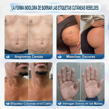 🏥🛒𝐏𝐢𝐜𝐝𝐨®  Borrador de Verrugas y Manchas en 7 Días (𝐀𝐩𝐥𝐢𝐜𝐚𝐝𝐨𝐫 𝐫𝐨𝐥𝐥-𝐨𝐧: 𝐬𝐢𝐧 𝐝𝐨𝐥𝐨𝐫 𝐧𝐢 𝐜𝐢𝐜𝐚𝐭𝐫𝐢𝐜𝐞𝐬)