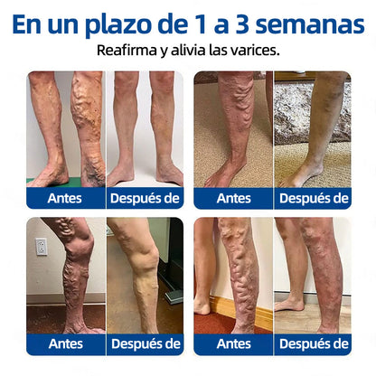 ✅𝐅𝐥𝐨𝐫𝐢𝐬𝐦𝐚®𝐎𝐛𝐣𝐞𝐭𝐢𝐯𝐨 𝐕𝐞𝐧𝐨𝐬𝐨 𝐏𝐚𝐫𝐜𝐡𝐞 𝐃𝐞 𝐌𝐢𝐜𝐫𝐨𝐚𝐠𝐮𝐣𝐚𝐬🩹🩹⚡Alivio instantáneo, resultados a largo plazo